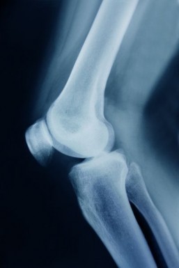 Physical therapy can be as good as knee surgery: study